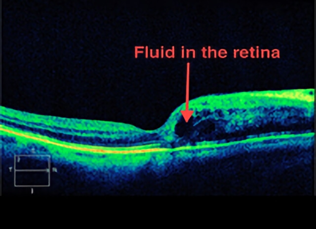 Branch Vein Occlusion 03