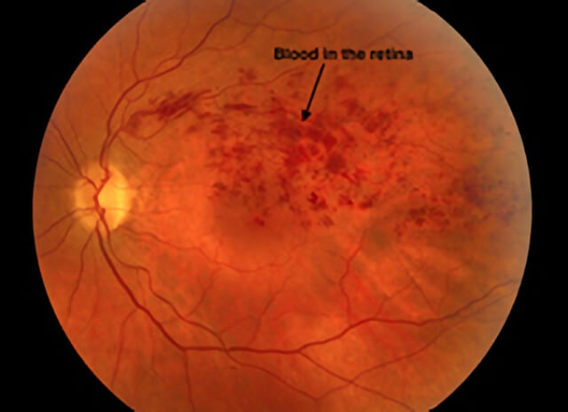 Branch Vein Occlusion 01