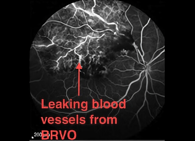 Branch Vein Occlusion 02