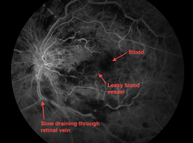 Central Vein Occlusion 03