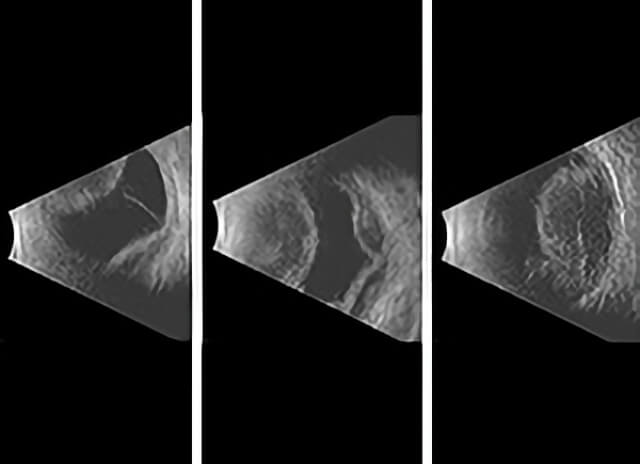 Choroidal Detachment