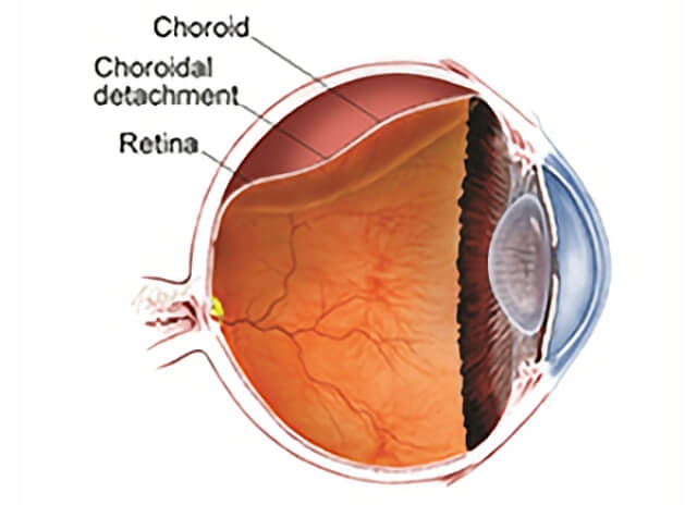 Choroidal Detachment