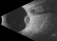 Choroidal Melanoma 01