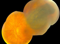 Choroidal Melanoma 02