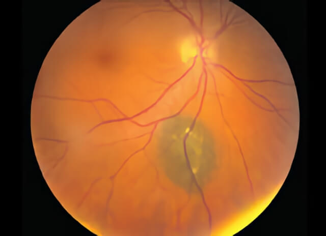 Choroidal Nevus 01