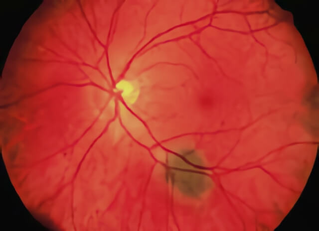 Choroidal Nevus 02