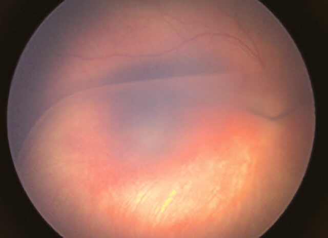 Congenital x-linked retinoschisis 2