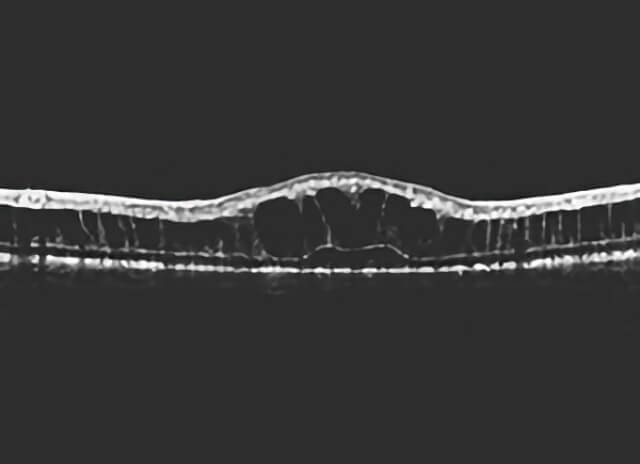 Congenital x-linked retinoschisis 3