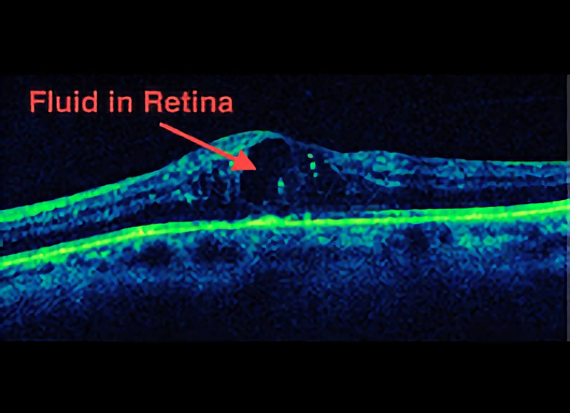 Diabetic Macular Edema 02