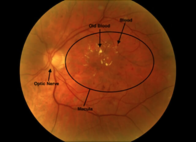 Diabetic Macular Edema 01