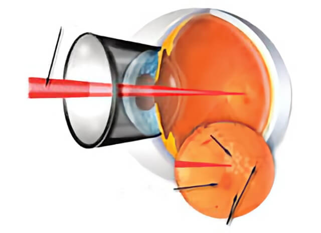 Diabetic Retinopathy 05