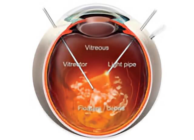 Diabetic Retinopathy 12