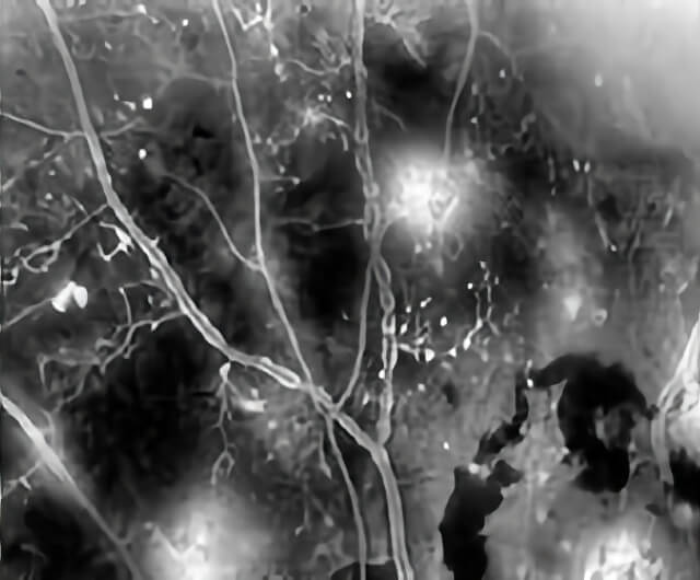 Diabetic Retinopathy 09