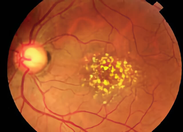 Macular Degeneration 01