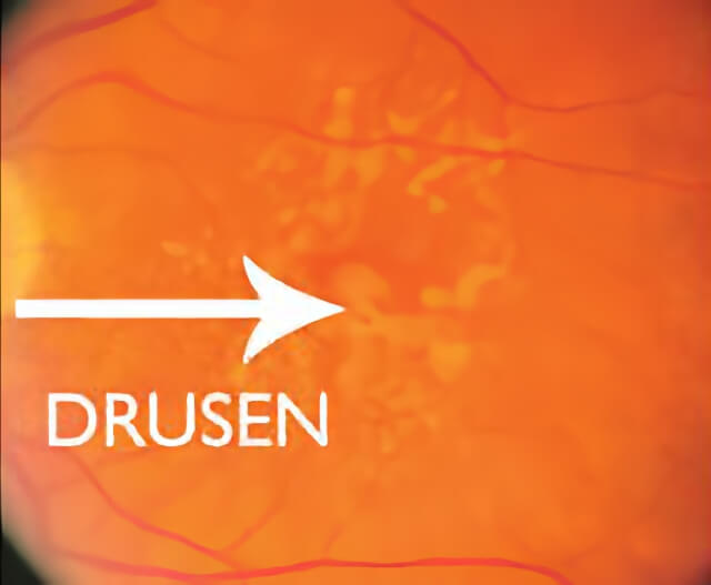Macular Degeneration 02