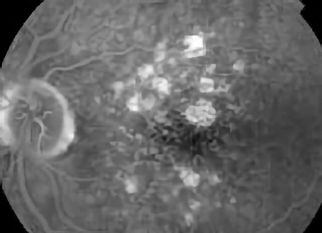Macular Degeneration 04