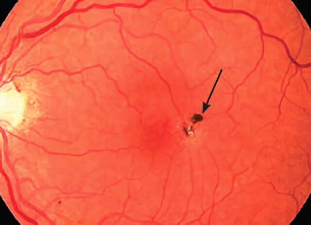 Idiopathic Juxtafoveal Telangiectasis 01