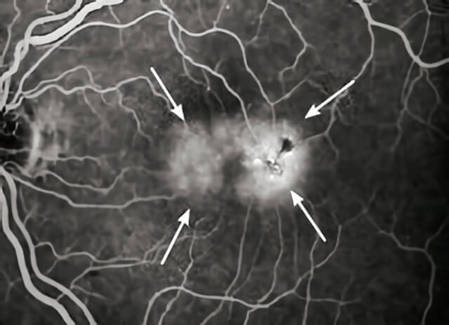 Idiopathic Juxtafoveal Telangiectasis 02