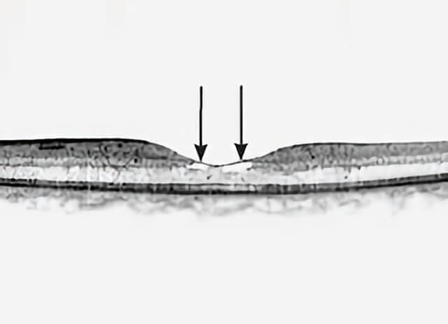 Idiopathic Juxtafoveal Telangiectasis 03