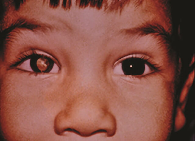 Infectious Retinitis 1