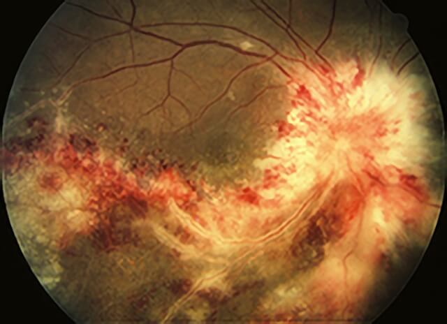 Infectious Retinitis 2