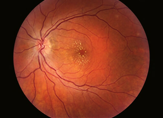 Infectious Retinitis 3