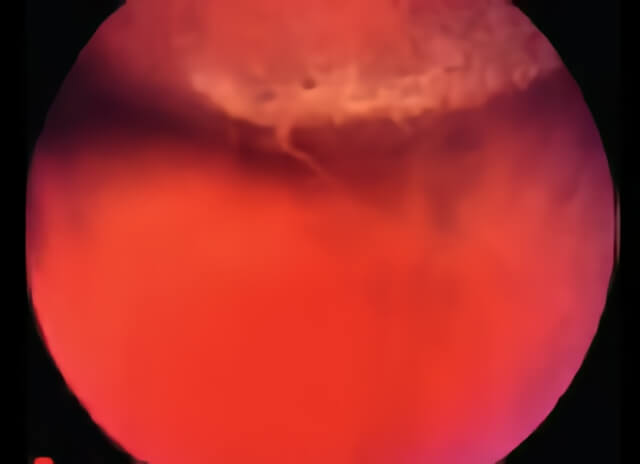 Lattice Degeneration 03