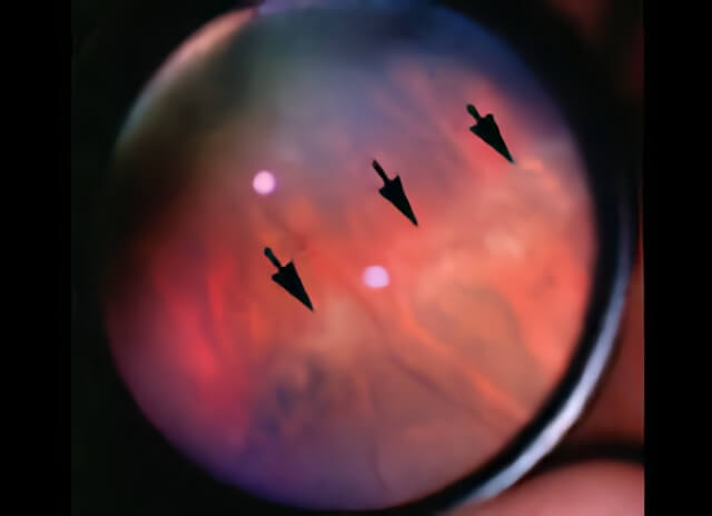 Lattice Degeneration 02