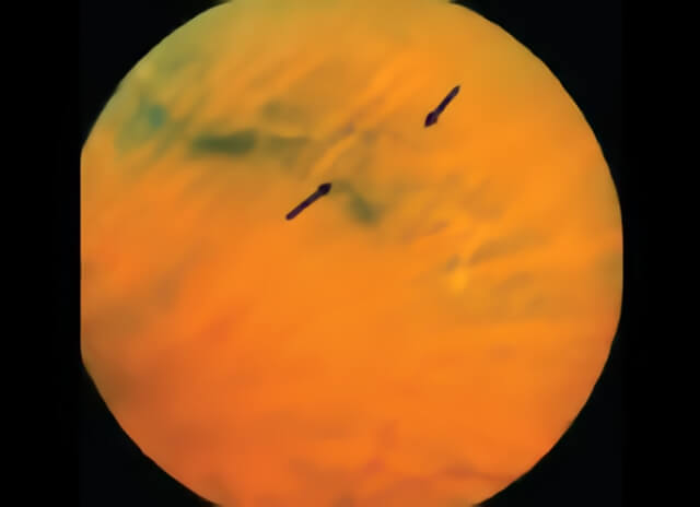 Lattice Degeneration 01