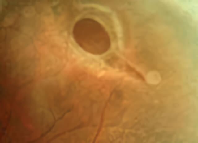 Lattice Degeneration 04