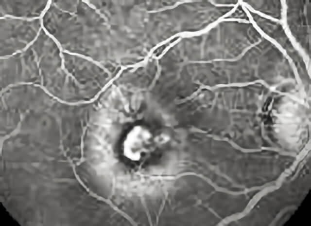 Macular Degeneration 06