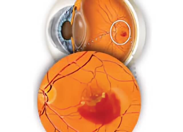 Macular Degeneration 05