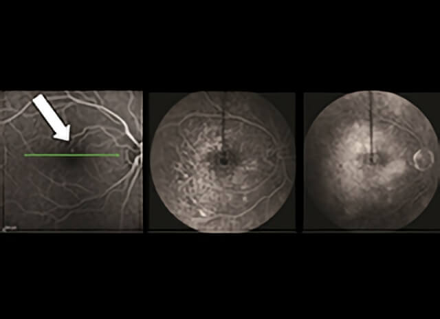 Macular Edema 1