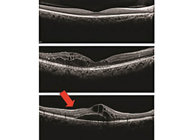 Macular Edema 2