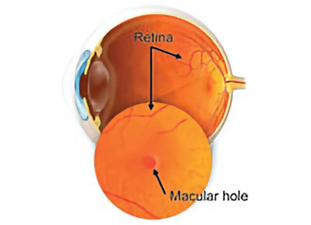 Macular Hole 01