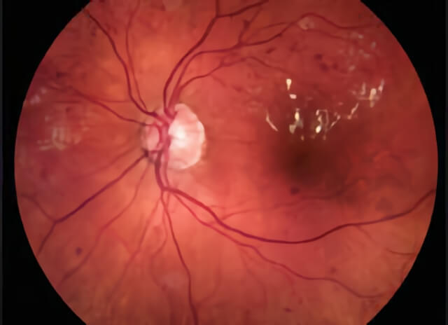 Diabetic Retinopathy 14