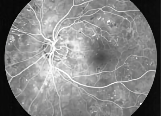 Diabetic Retinopathy 15