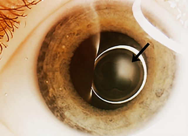 Persistant Fetal Vasculature 1