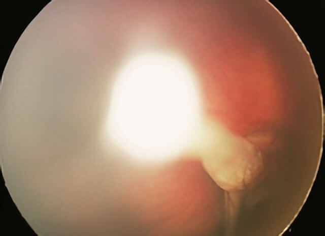 Persistant Fetal Vasculature 2