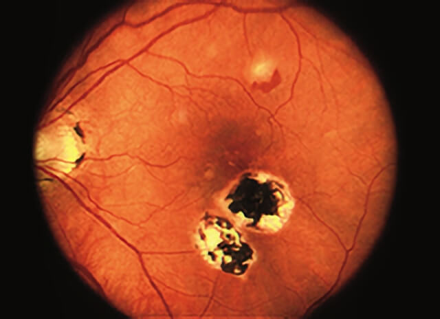 Presumed Ocular Histoplasmosis Syndrome 1