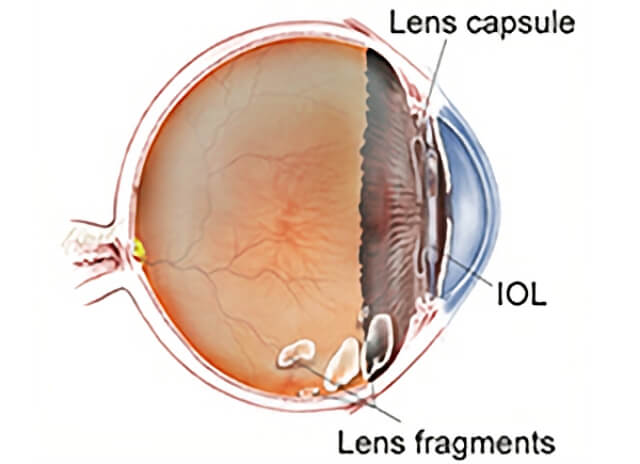 Retained Len Fragments 1