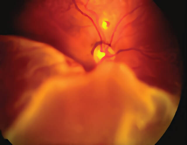 Surgical Repai Retinal Detachment 01