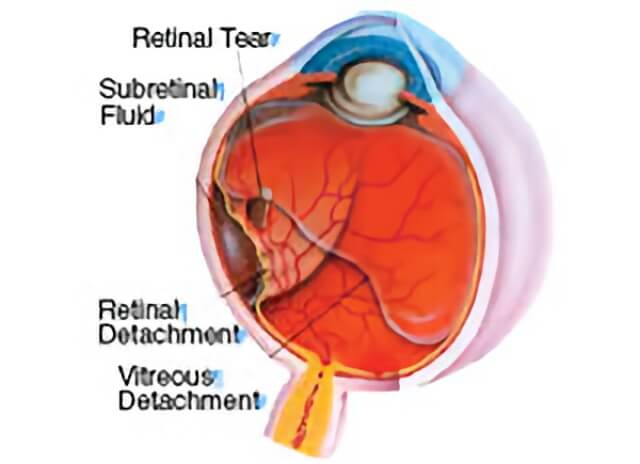 Retinal Detachment 03