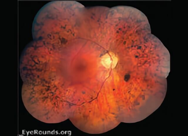 Retinitis Pigmentoda 01