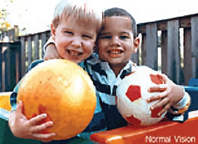 Retinitis Pigmentoda 02