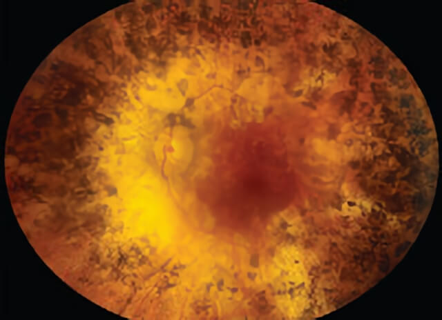 Retinitis Pigmentoda 04