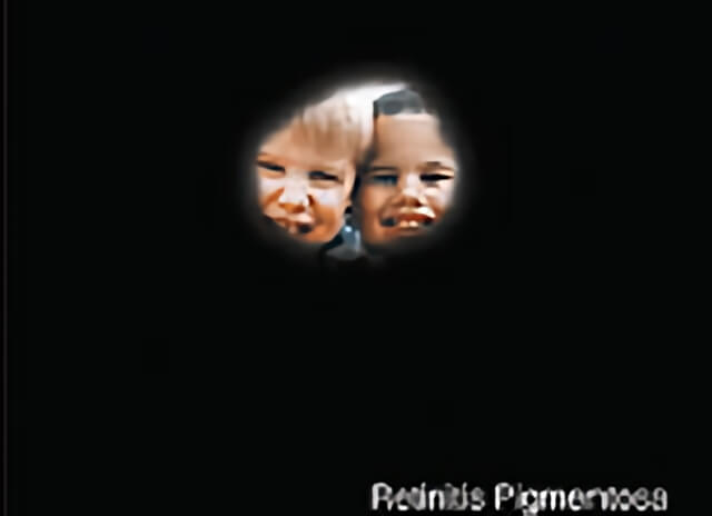 Retinitis Pigmentoda 03