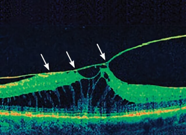 Vitreomacular Traction 02