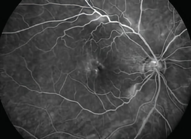 Vitreomacular Traction 01