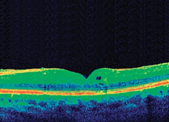 Vitreomacular Traction 03